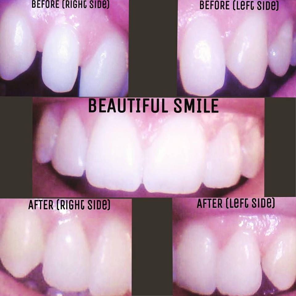 Cosmetic Dentistry-Before and After