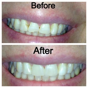 Woodbridge Dentist, Dentist in Woodbridge, Vaughan Dentist, Dentist in Vaughan, Componeers, Smile, Whiten, Insurance, Cool Dental, Before and After, Emergency, Emergency Dentist, Innovation Drive Dental, Spa-like atmosphere, Painless, Quick and Easy, Straight teeth, Change shape of teeth