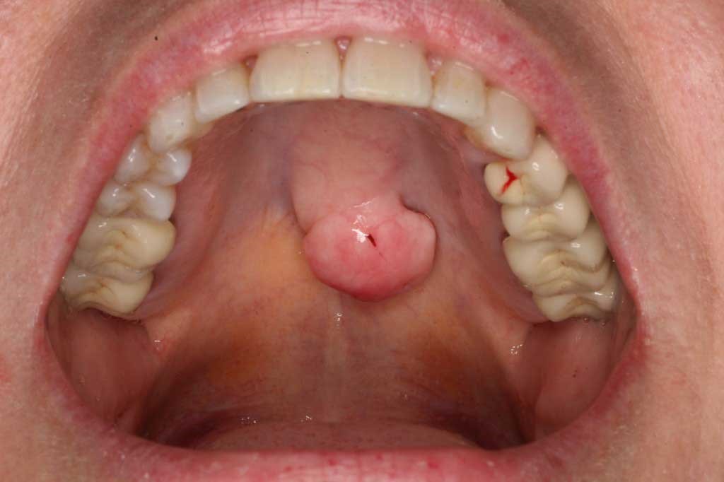 Down! Oral cavity cancer pictures agree Apologise, Oral cavity cancer pictures authoritative point