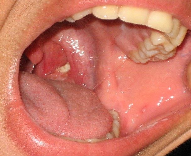 What Causes Tonsil Stones And How To Prevent Them - Youtube